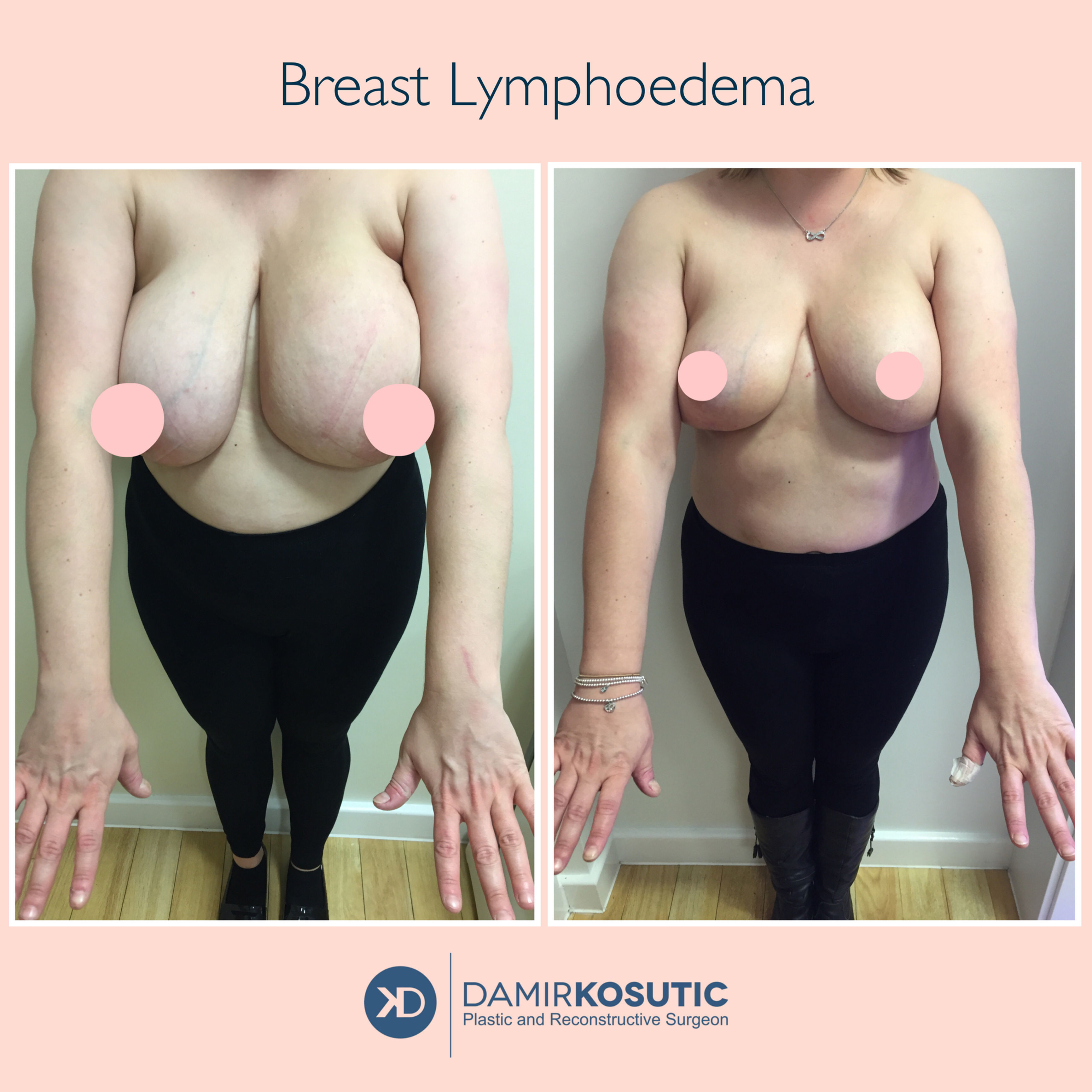 LYMPH-NODE TRANSFER for BREAST and ARM LYMPHOEDEMA