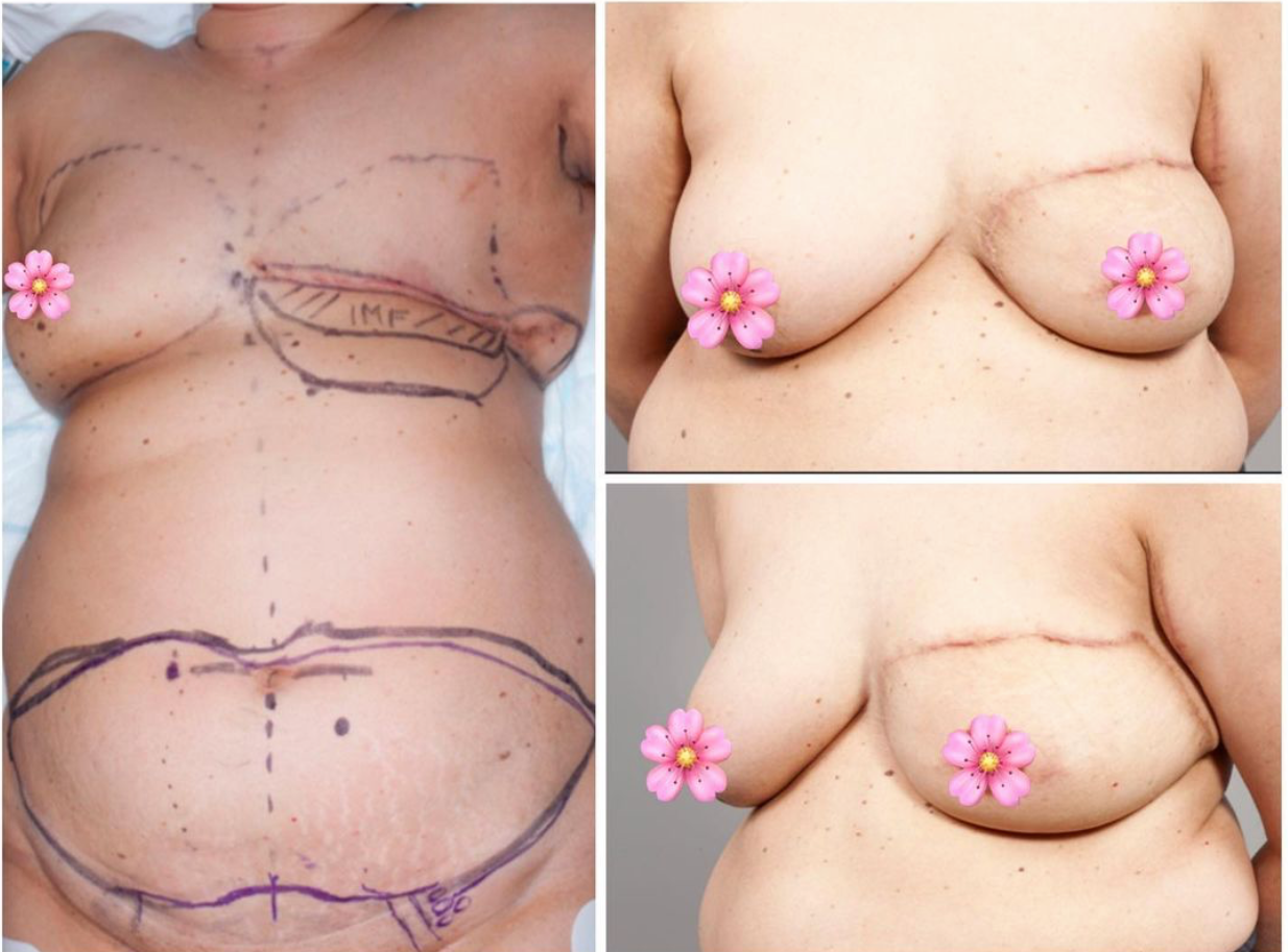 DIEP FLAP BREAST RECONSTRUCTION