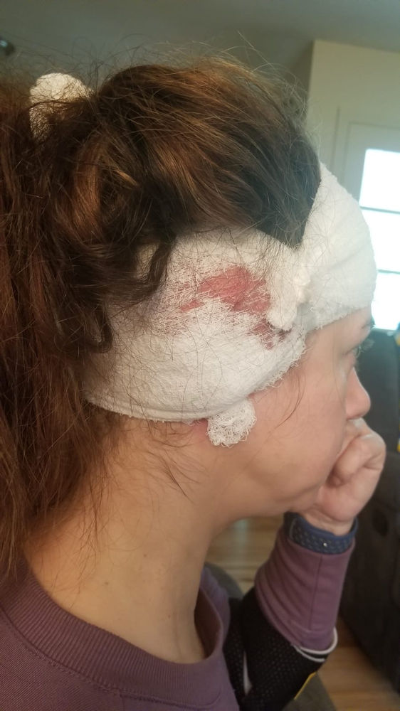 Cholesteatoma Surgery My Experience