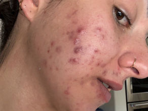 Acne Isn’t Random: The Root Causes No One Is Talking About