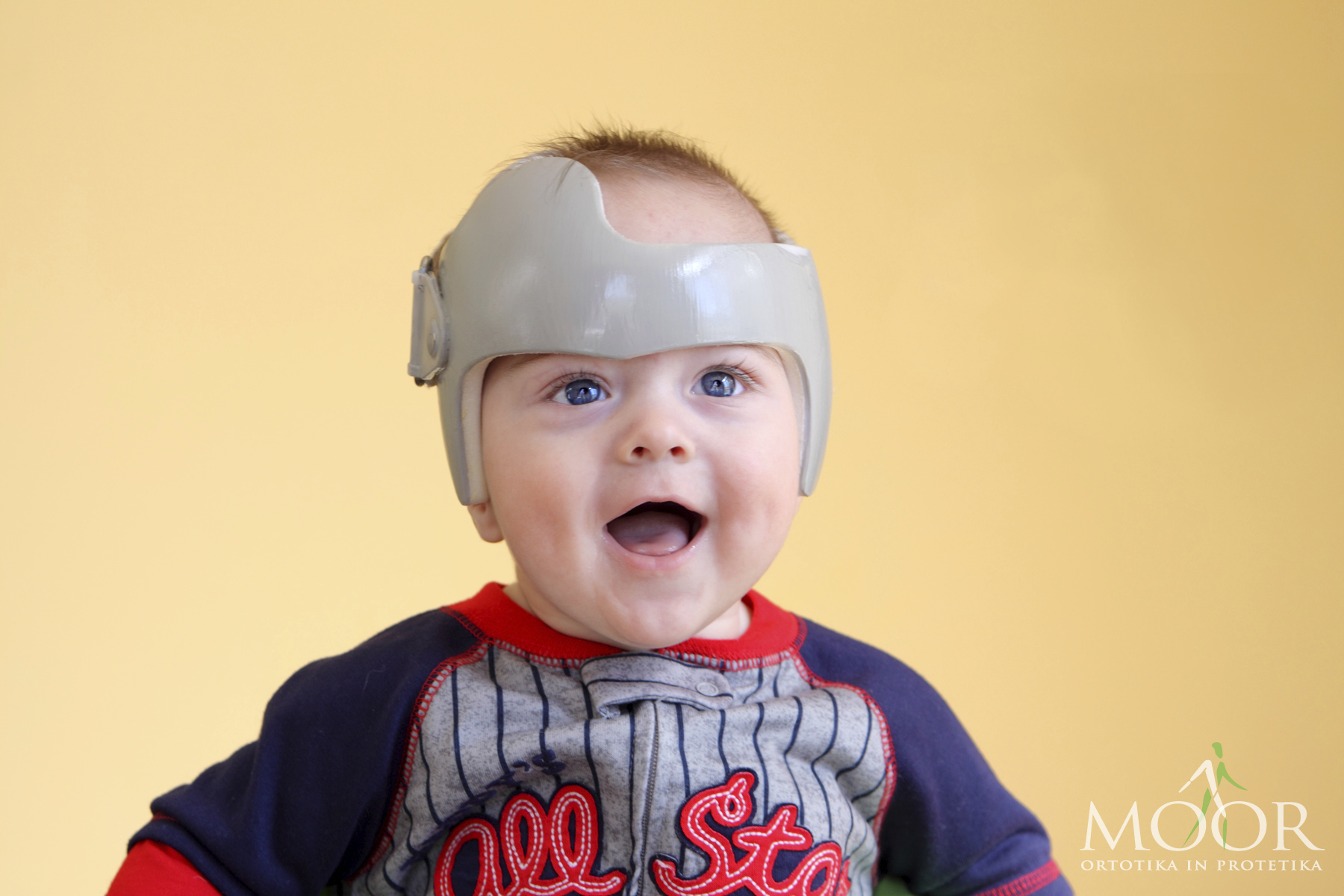 PLAGIOCEPHALY