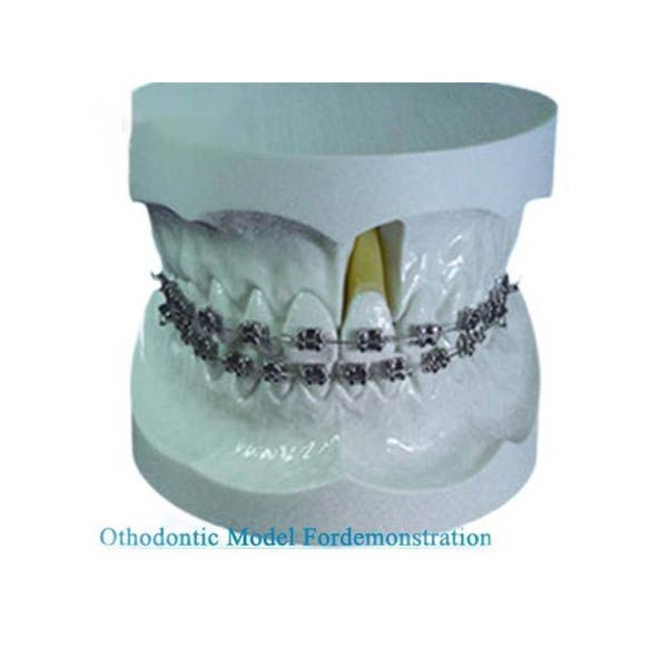 Orthodontic Model For Demonstration With Edgewise Bracket