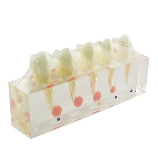 DS-L3A Clinical Model of Tooth and Dental Pulp Disease