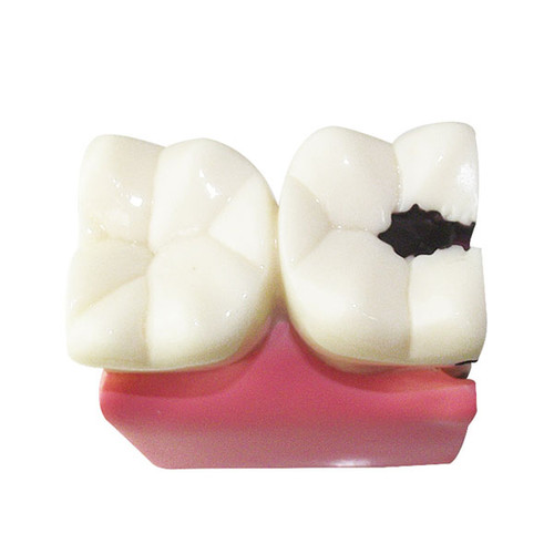 Dental caries model/dental model/dental study model | Dentalshop Com
