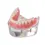Thumbnail: Mandibular overdenture implant teeth model with 4 implants