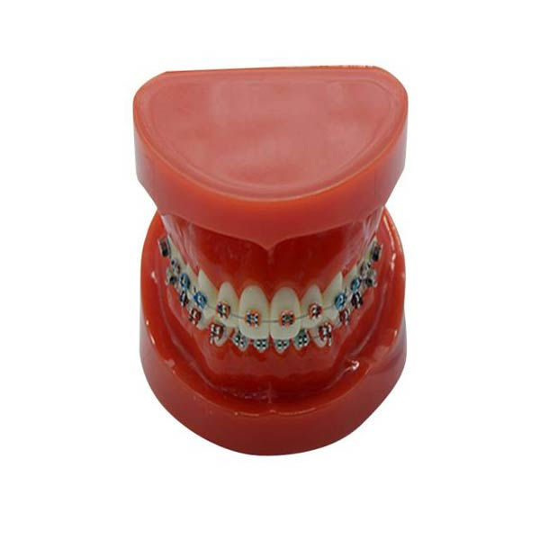 DS-B16 Study Model With Fixed Braces On Teeth (Normal)