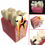 Thumbnail: Dental caries model/dental model/dental study model