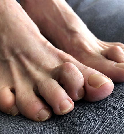 patient suffering from hammertoe