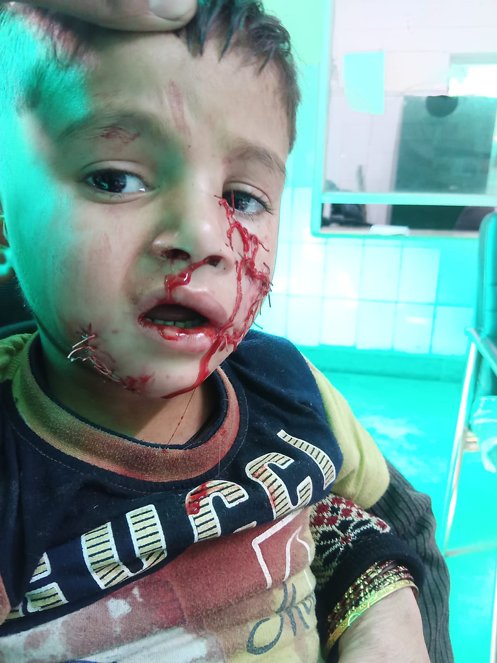 आवारा कुत्ते के हमले में घायल मासूम शांतनु,