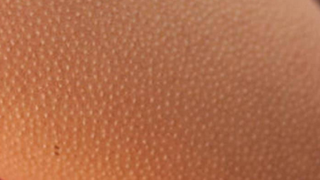 Keratosis Pilaris skin condition