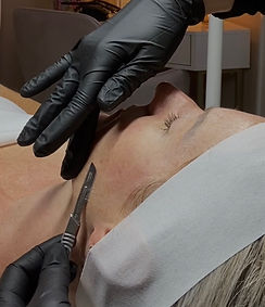 dermaplane facial