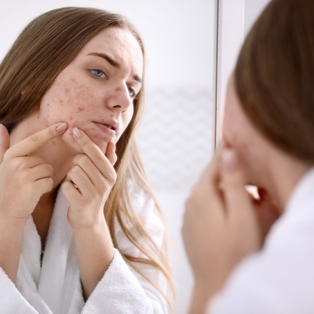 BLACKHEADS, SPOTS AND ACNE