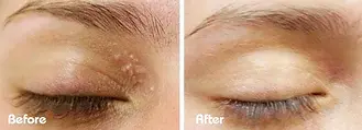 Facial Milia Removal