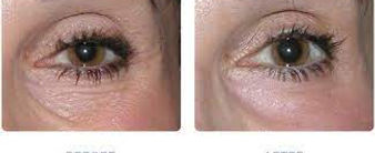 Eye lift Non surgical