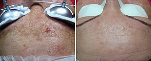 Melasma Laser Treatment