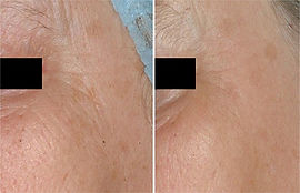 Skin Resurfacing Laser Treatment