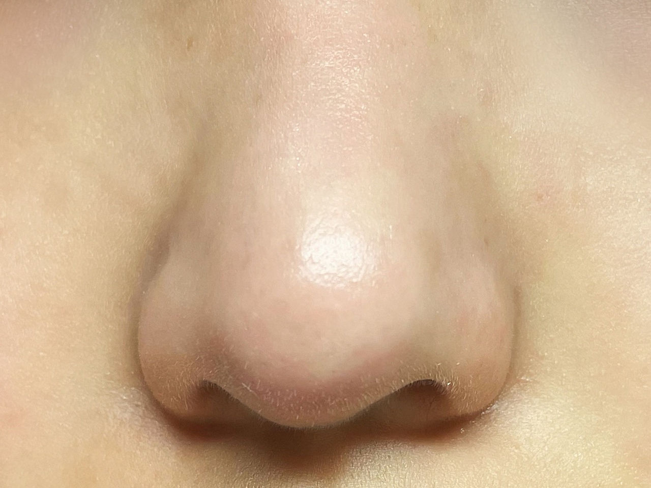 remove blackheads, blackheads removal reddit, blackhead removal facial, blackhead whitehead, salicylic acid, webMD, blackheads on cheeks, how to close pores after removing blackheads reddit