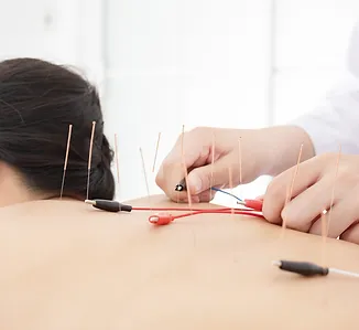 electro-acupuncture