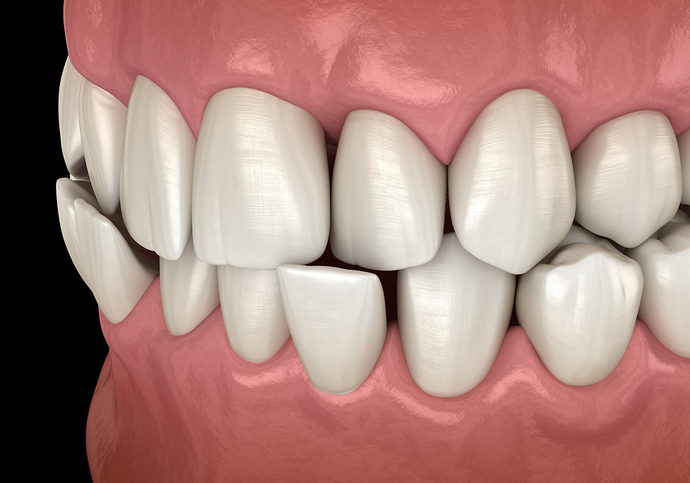 What causes a crossbite?