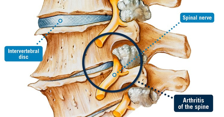 Regenerative Therapy Spinal Arthritis