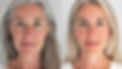 Microneedling  .jpeg