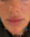 Lip Filler