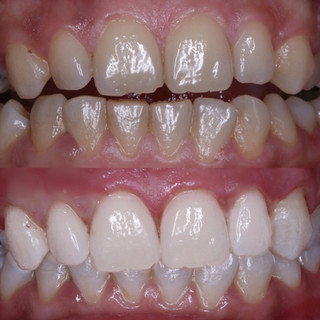 Biowhiten Biyolojik Dis Beyazlatma Turkiye Biodent Medical