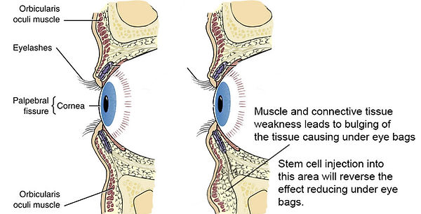 Dark circles - eye bags