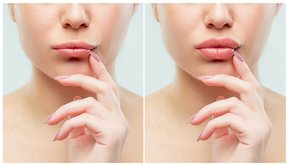 Lip Dermal Filler