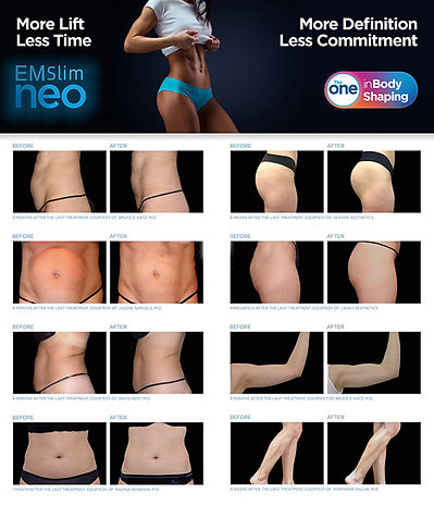 EM Slim before and after