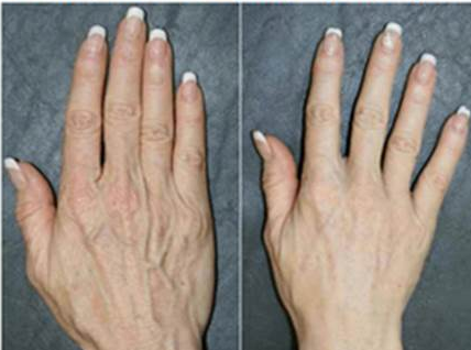Hands dermal filler before and after