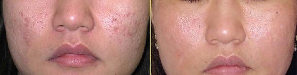 Micro Needling Acne Scars