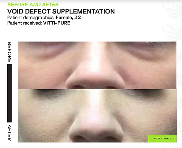 Under eye bags - stem cells