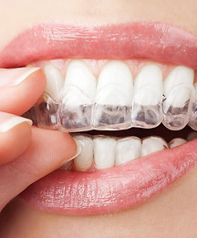 Invisalign with Dr. Dunn