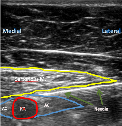 pnbschool-learn-ultrasound-guided-adductor-canal-blocks
