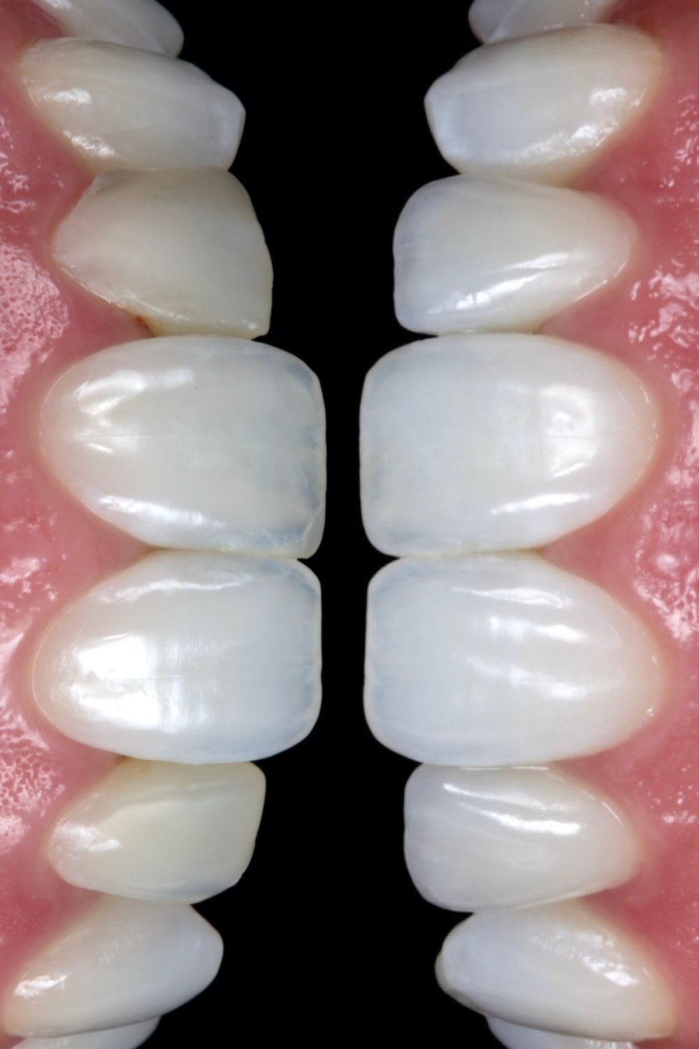 Lentes de contato dentais antes e depois. Daniel Malta Dentista em Florianópolis.