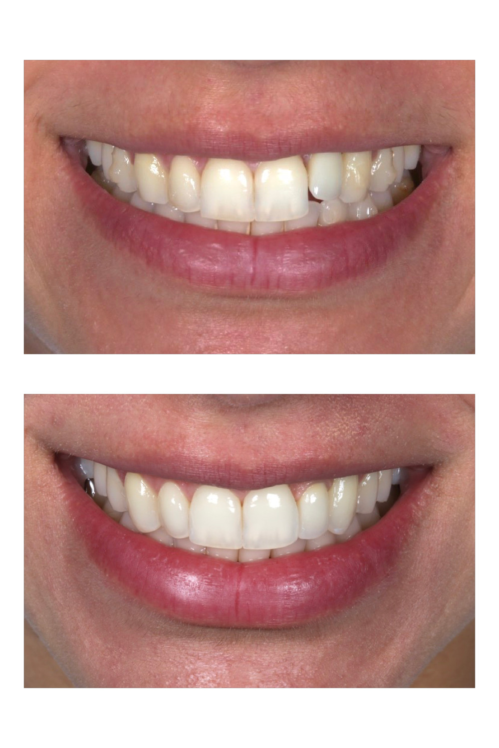 Lente de contato dental