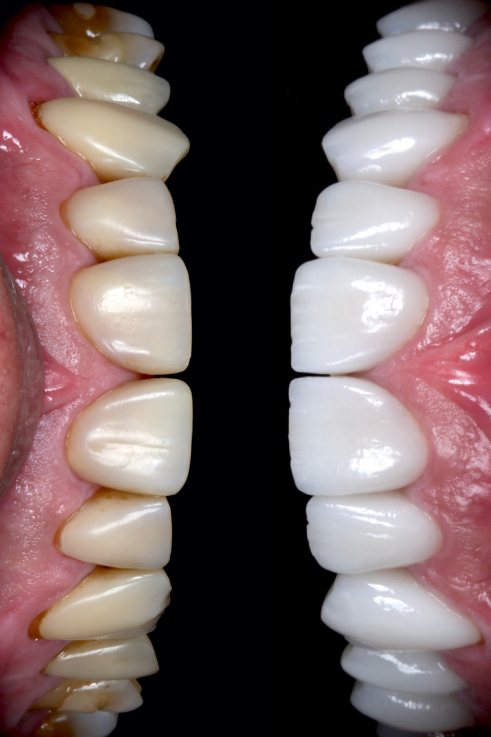 lente de contato dental antes e depois