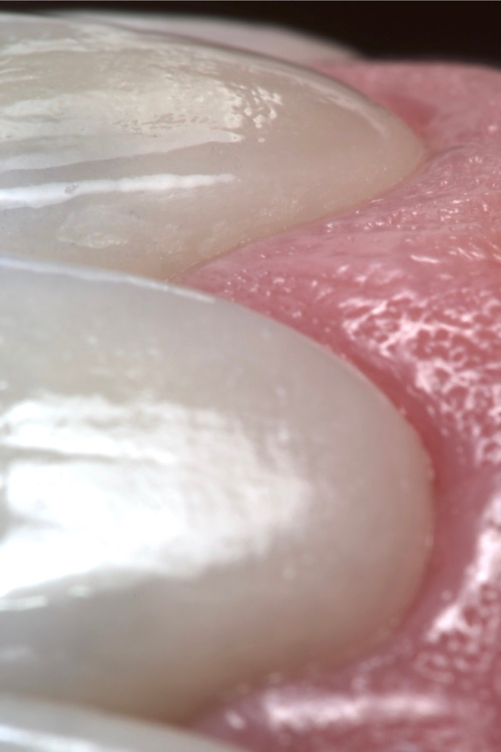 Facetas de porcelana. Daniel Malta Odontologia Estética em Florianópolis.