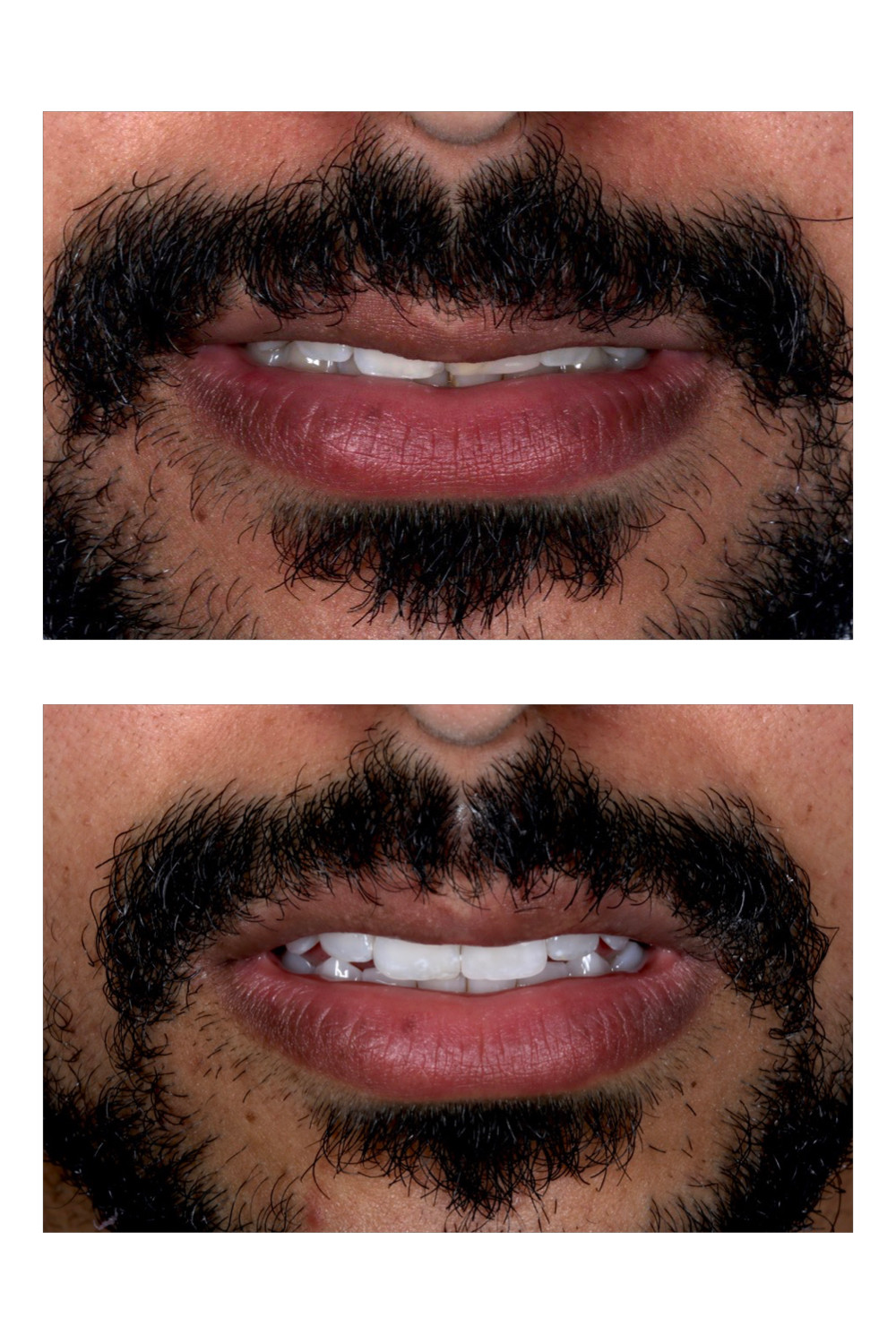 Clareamento dental associado a resina composta e uma faceta de porcelana no incisivo superior esquerdo.