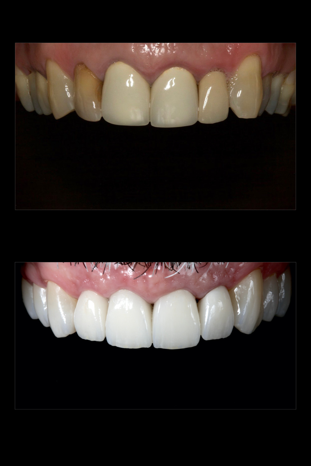 lente de contato dental antes e depois