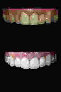 lente de contato dental antes e depois