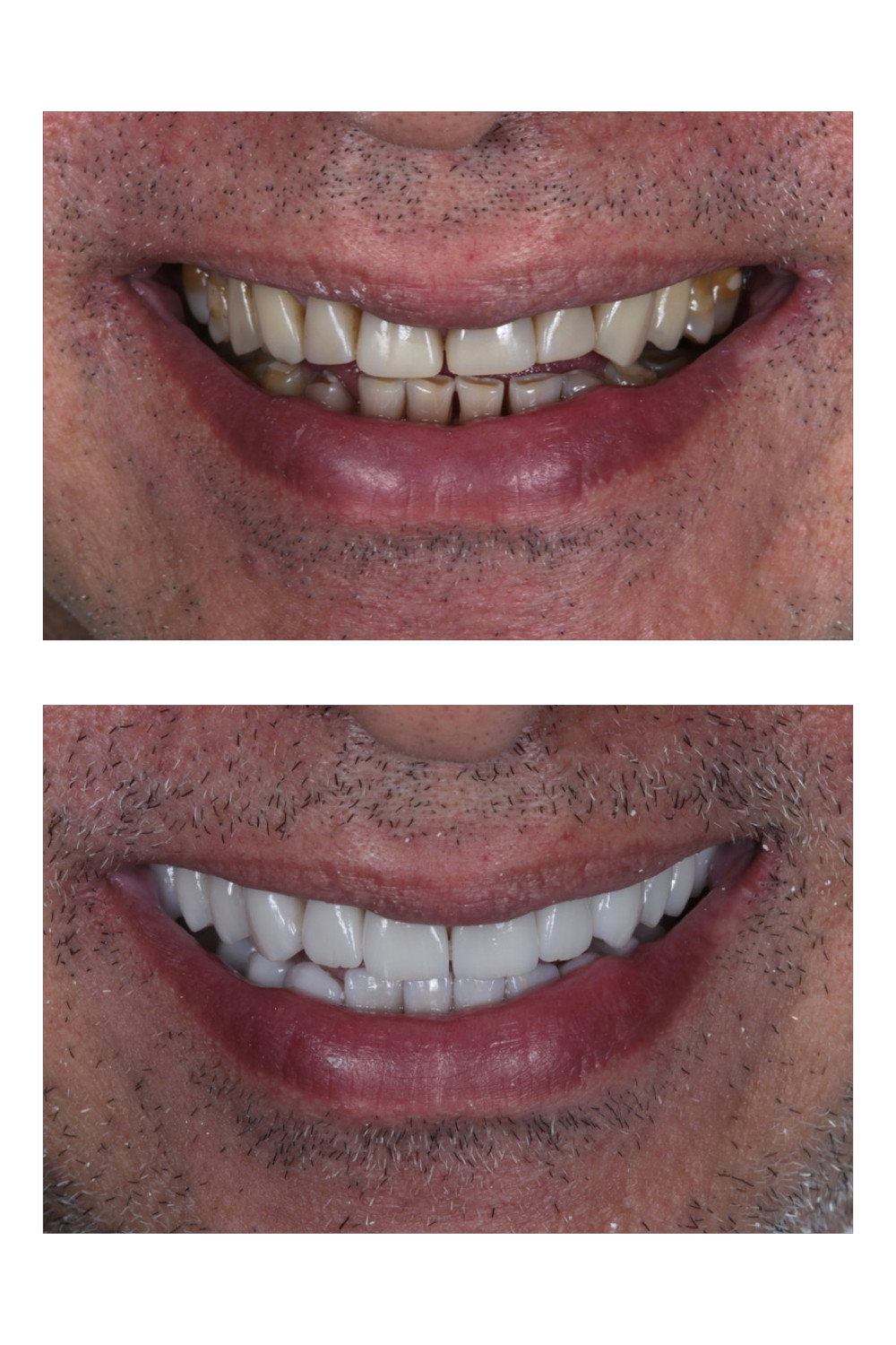 Lente de contato dental