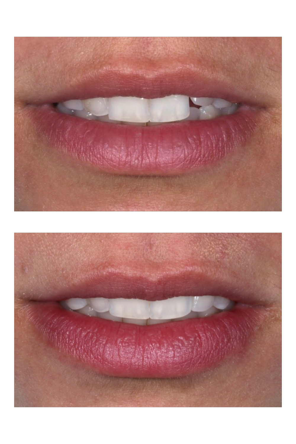 Clareamento dental associado a resina composta e uma faceta de porcelana no incisivo superior esquerdo.