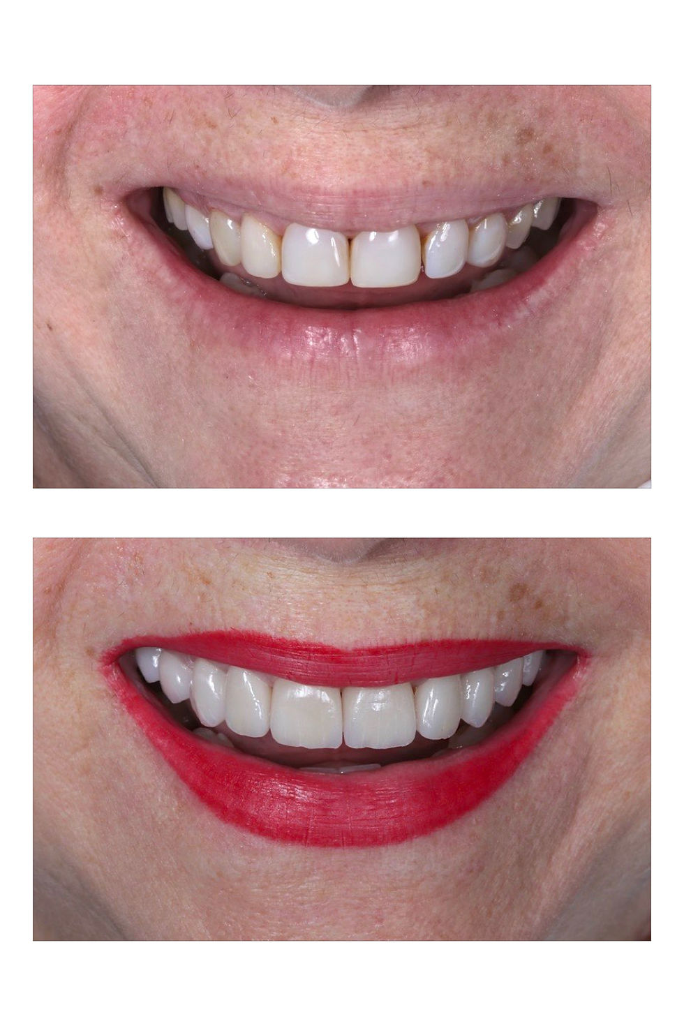 Lente de contato dental