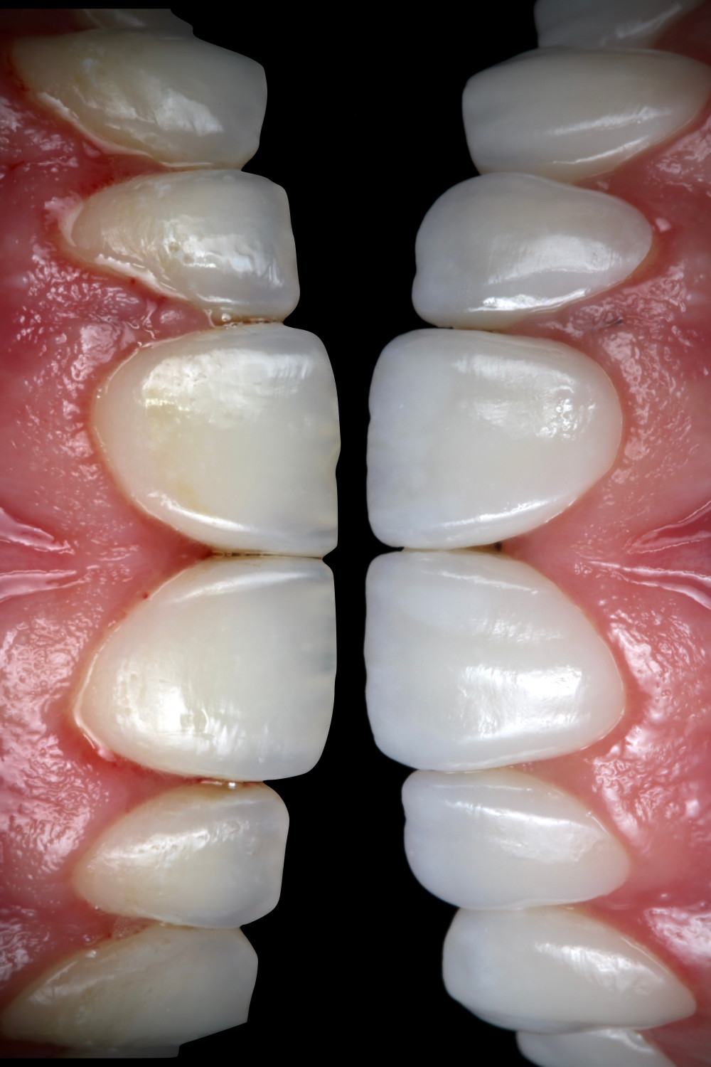 Lentes de contato dentais antes e depois. Daniel Malta Dentista em Florianópolis.