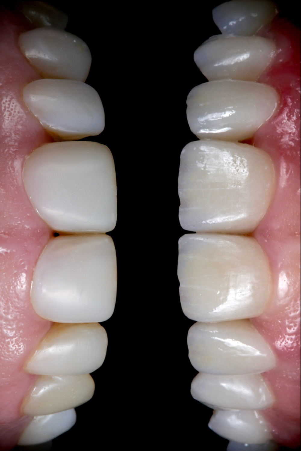 Clareamento dental associado a resina composta e uma faceta de porcelana no incisivo superior esquerdo.