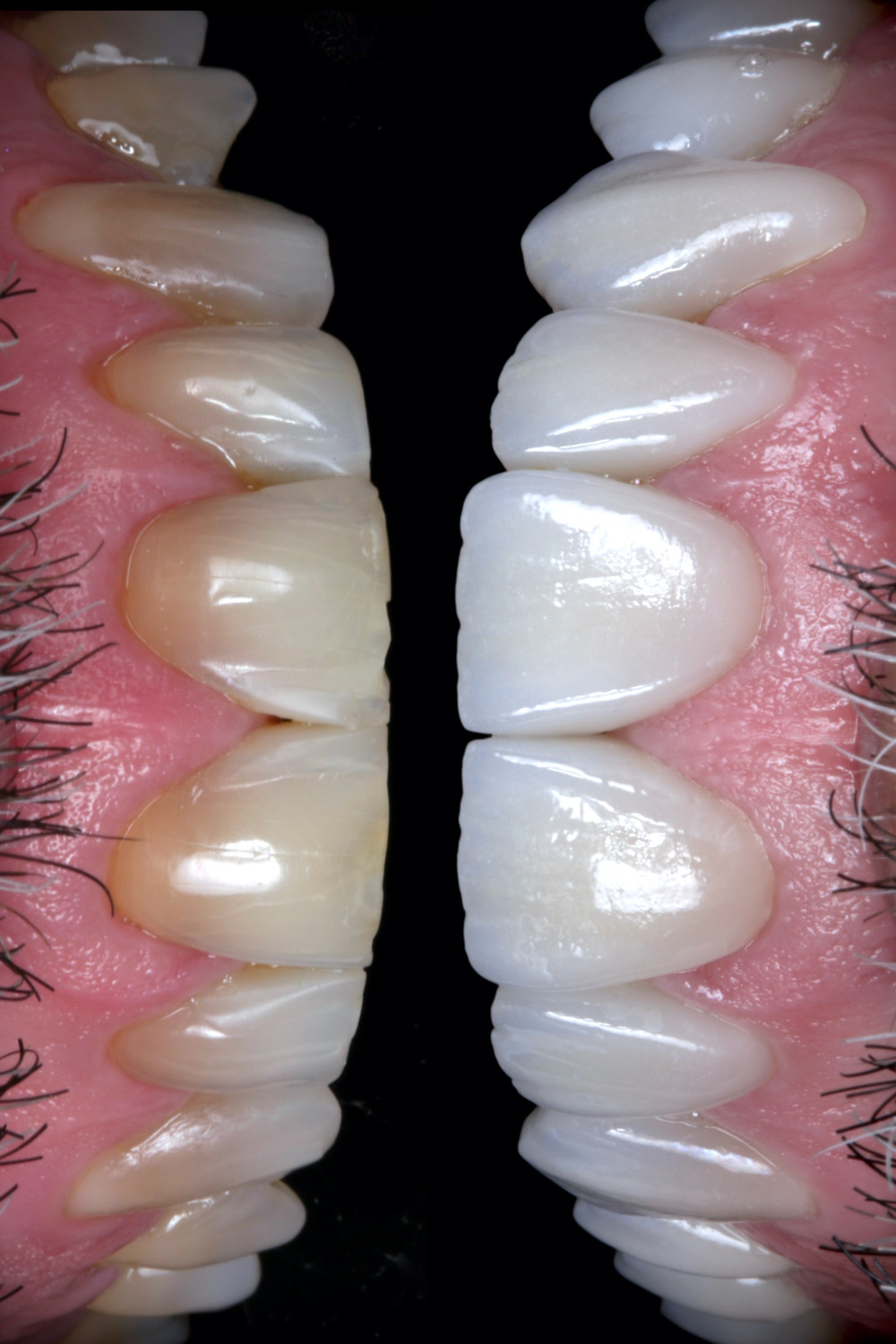 Lentes de contato dentais antes e depois. Daniel Malta Dentista em Florianópolis.