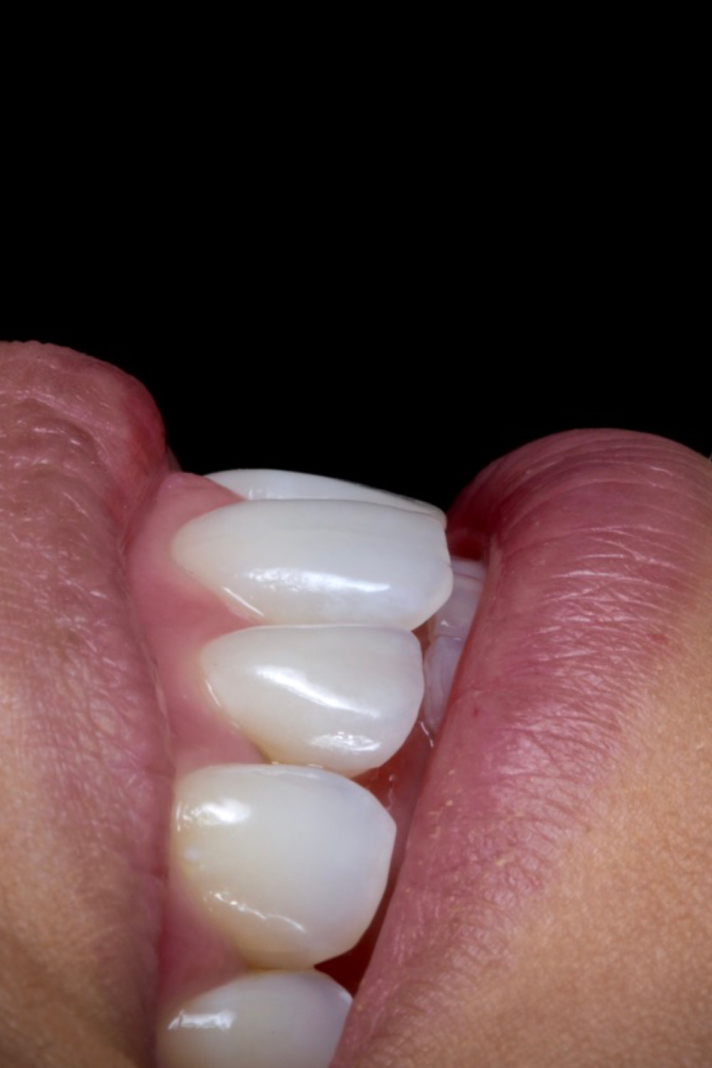 Facetas de porcelana. Daniel Malta Odontologia Estética em Florianópolis.