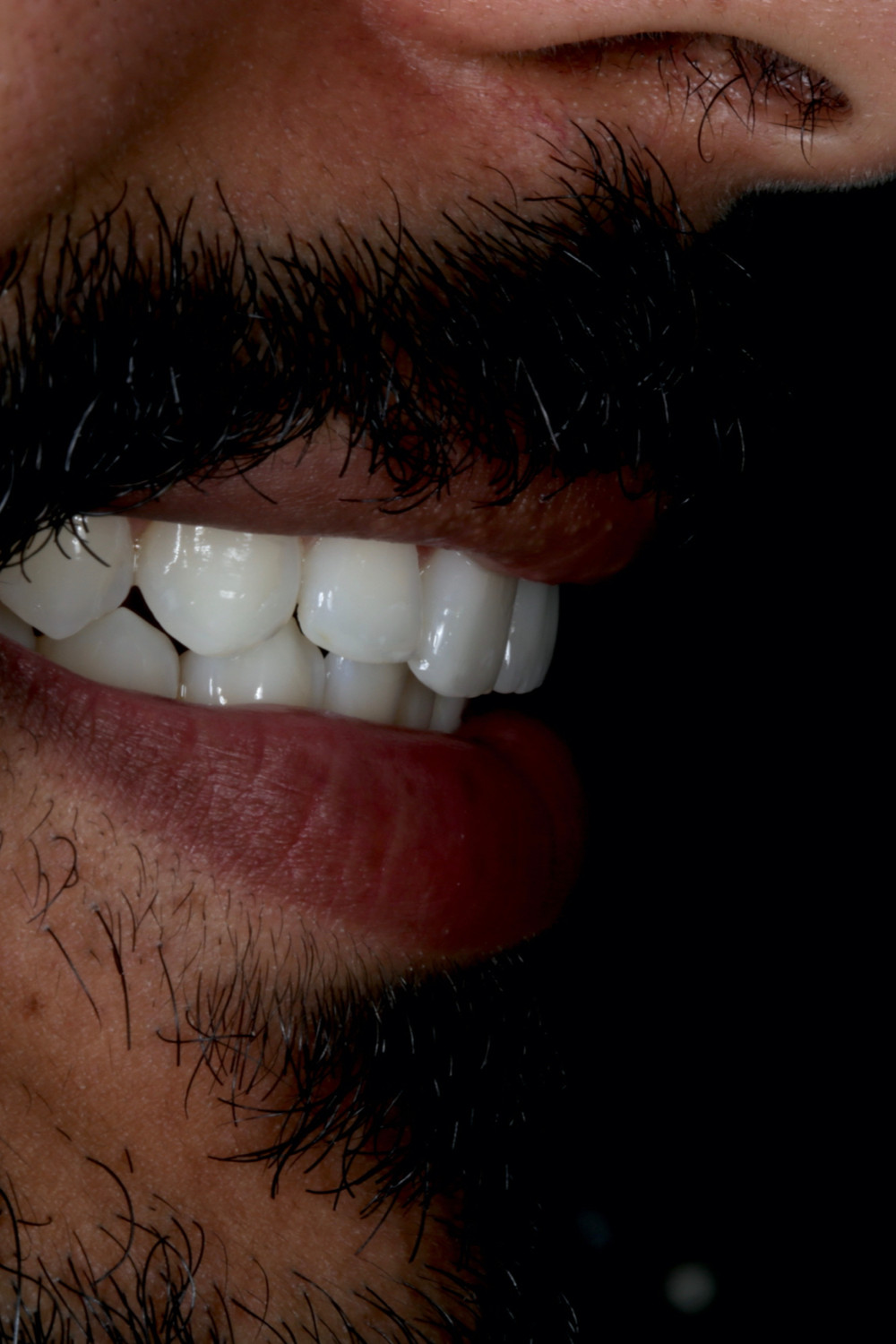 Clareamento dental seguido de restaurações de resina e uma porcelana